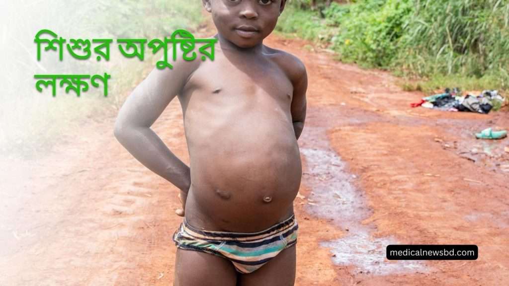 Child Malnutrition